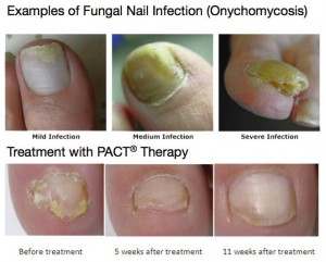 Fungal nail infection